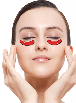 RF Eye Beauty Instrument To Remove Fine Lines